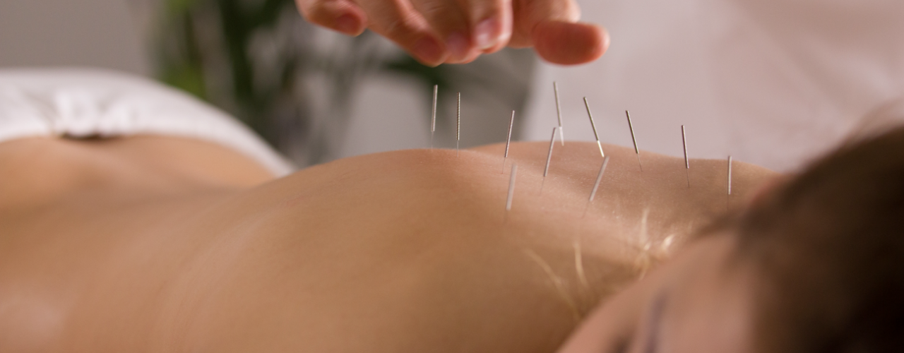Dry-Needling-Beyond-Therapy-and-Wellness-Bedford-TX