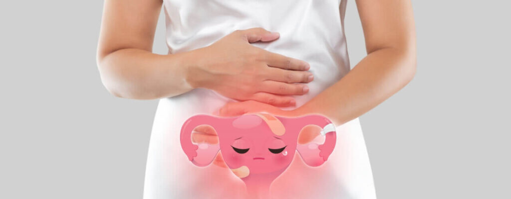 Find relief from endometriosis pain with physical therapy